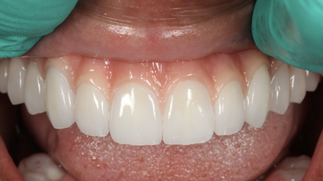 DENTAL IMPLANT HYBRIDS