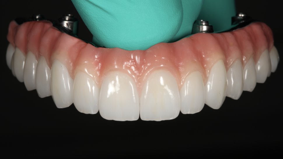 DENTAL IMPLANT HYBRIDS